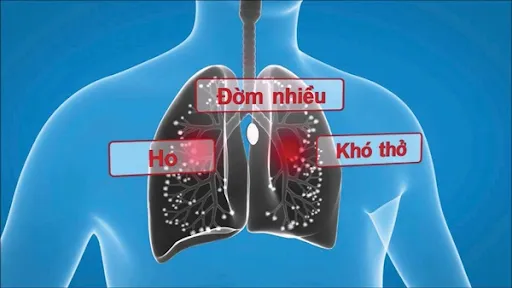 Các triệu chứng ho đờm khó thở thường gặp ở người bệnh viêm phổi